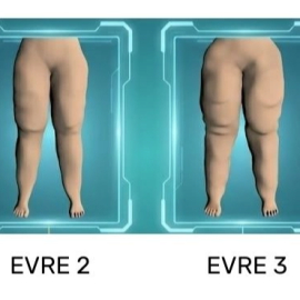 Su İçsem Yarıyor Diyorsanız Lipödem Olabilirsiniz